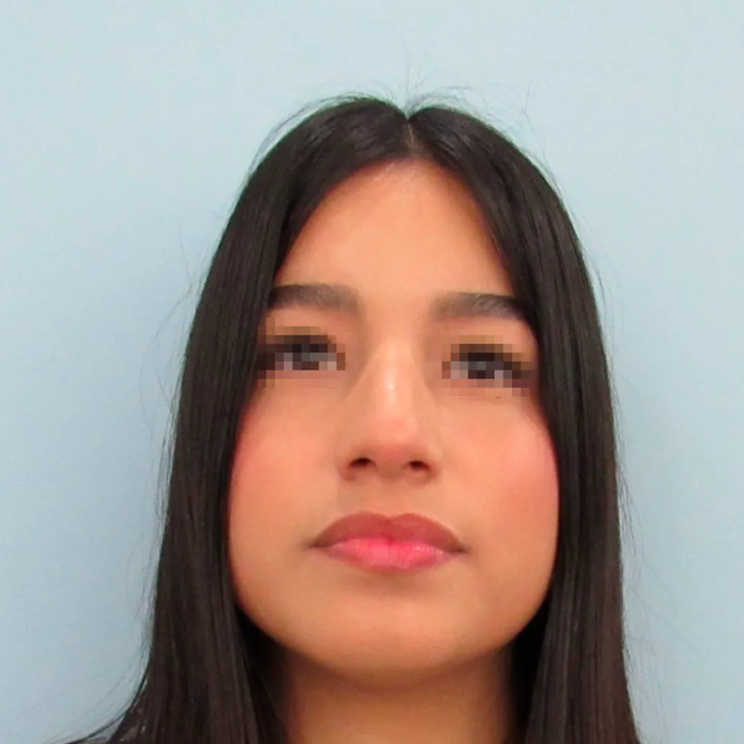 Rinoplastia — antes