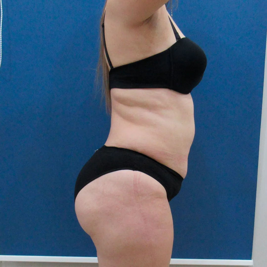 Abdominoplastia — antes