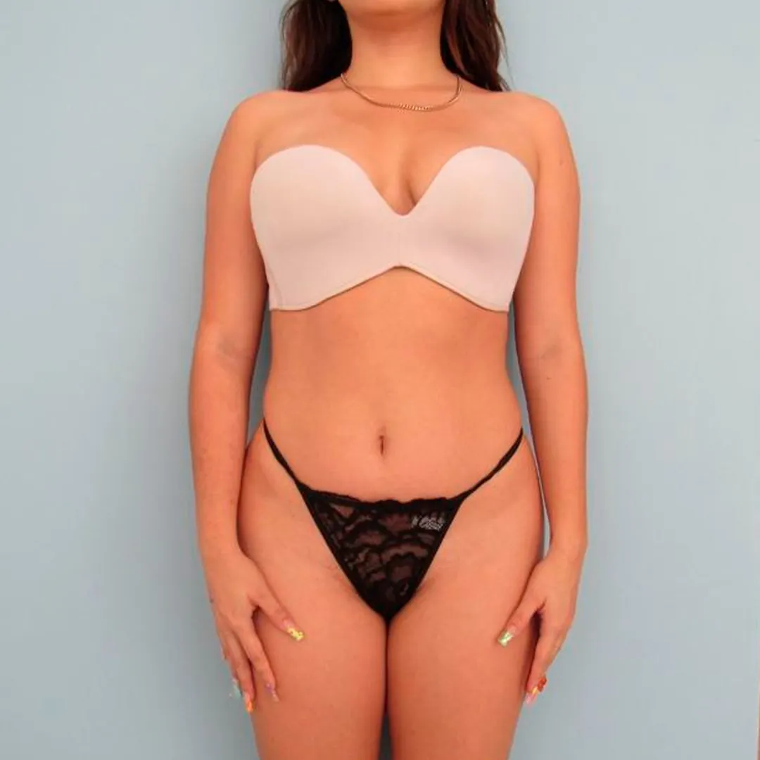 Lipoescultura — antes