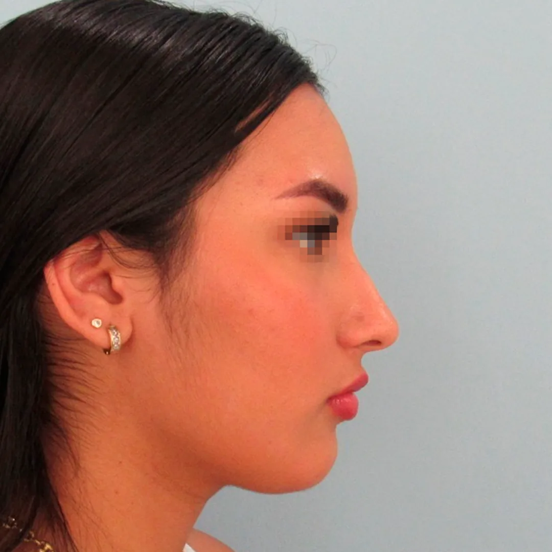 Rinoplastia — antes
