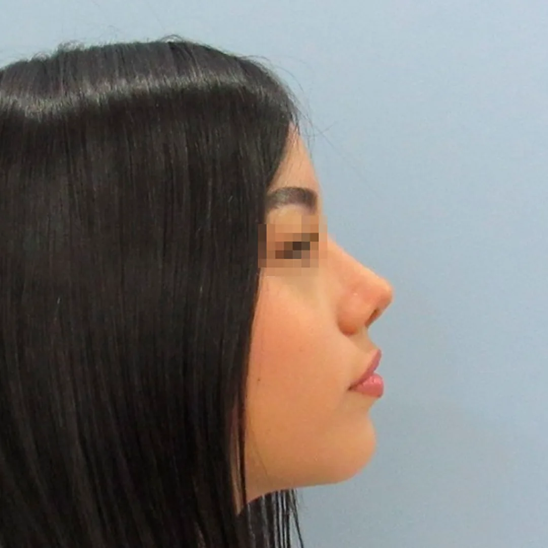 Rinoplastia — después
