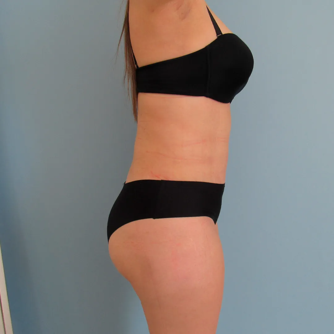 Abdominoplastia — después