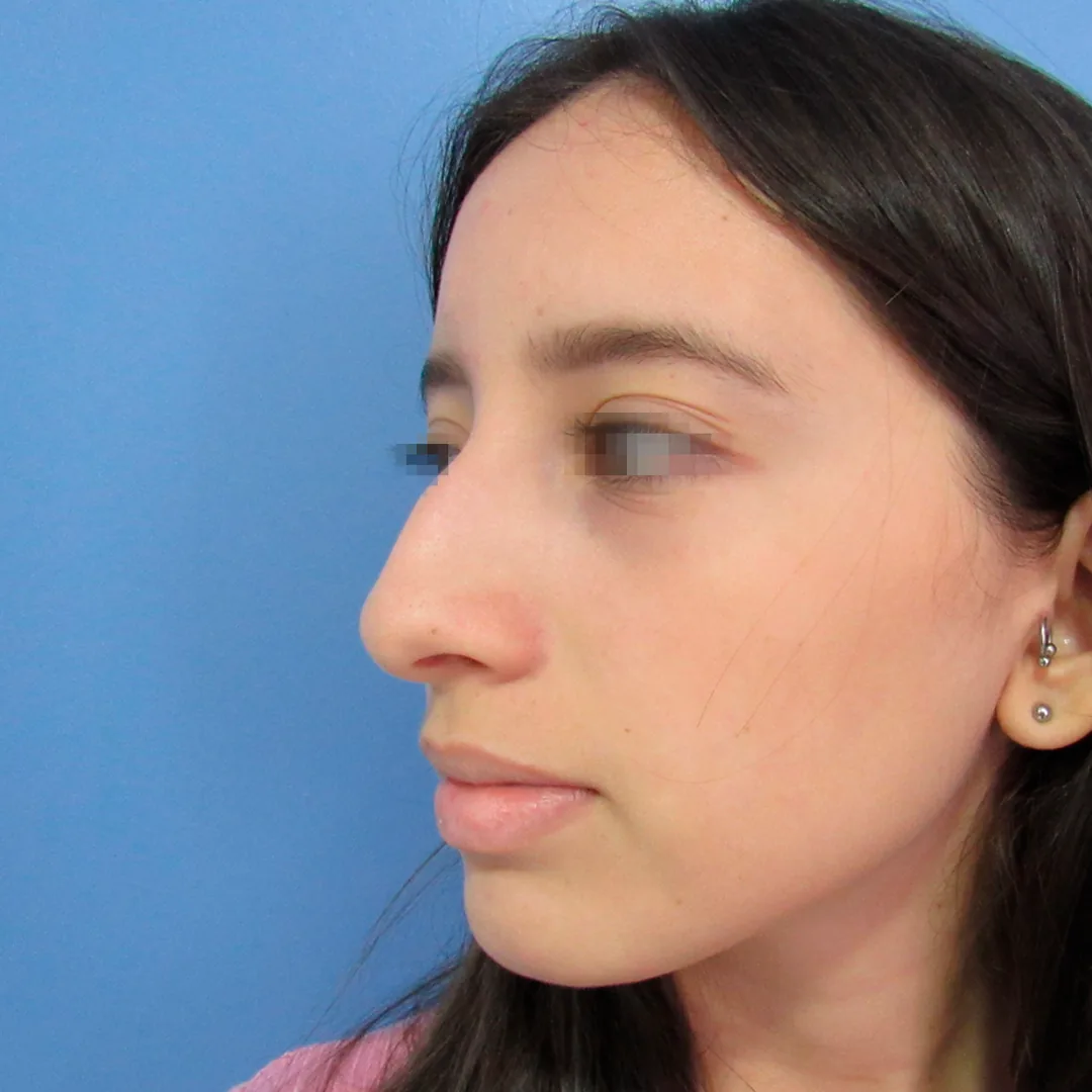 Rinoplastia — antes