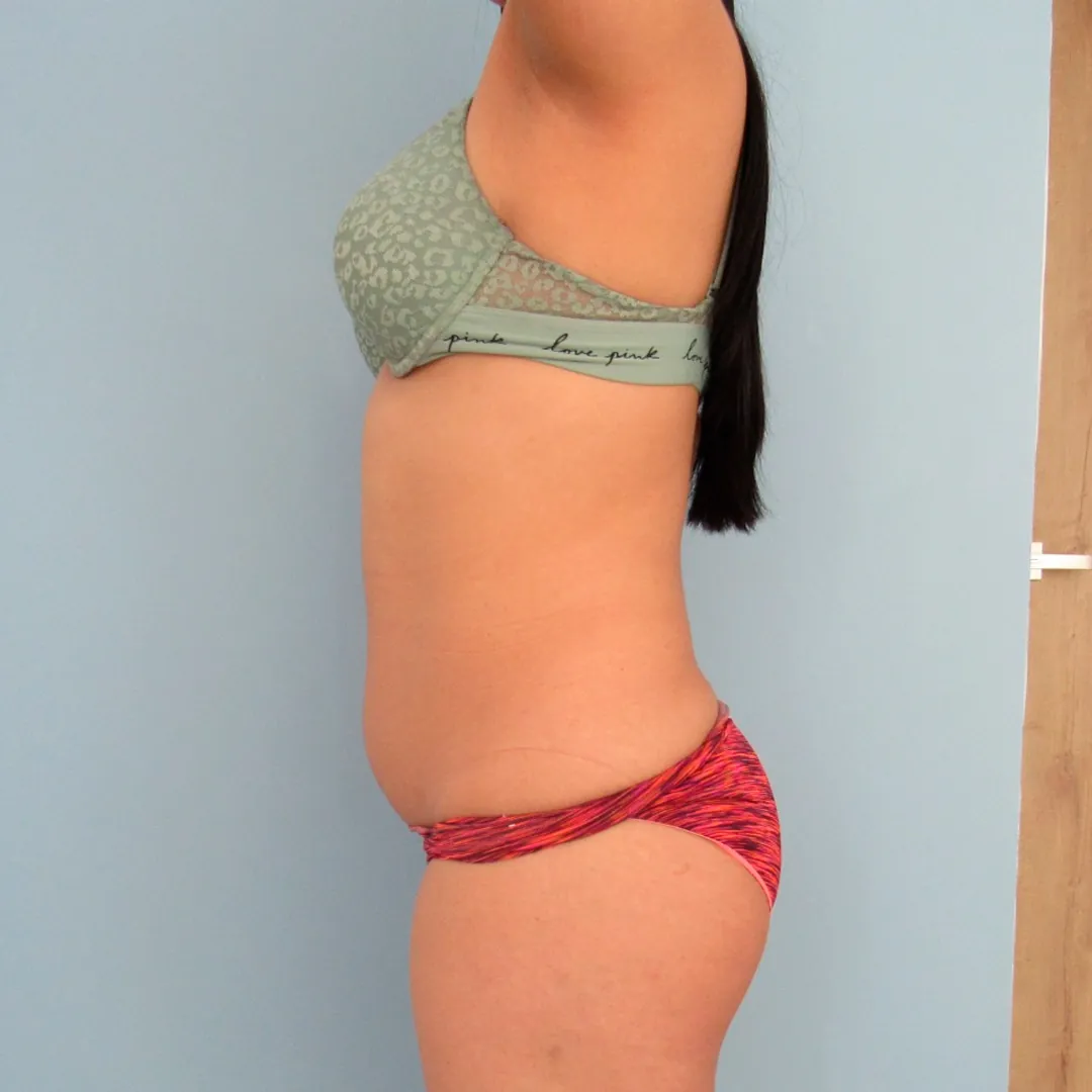 Abdominoplastia — antes