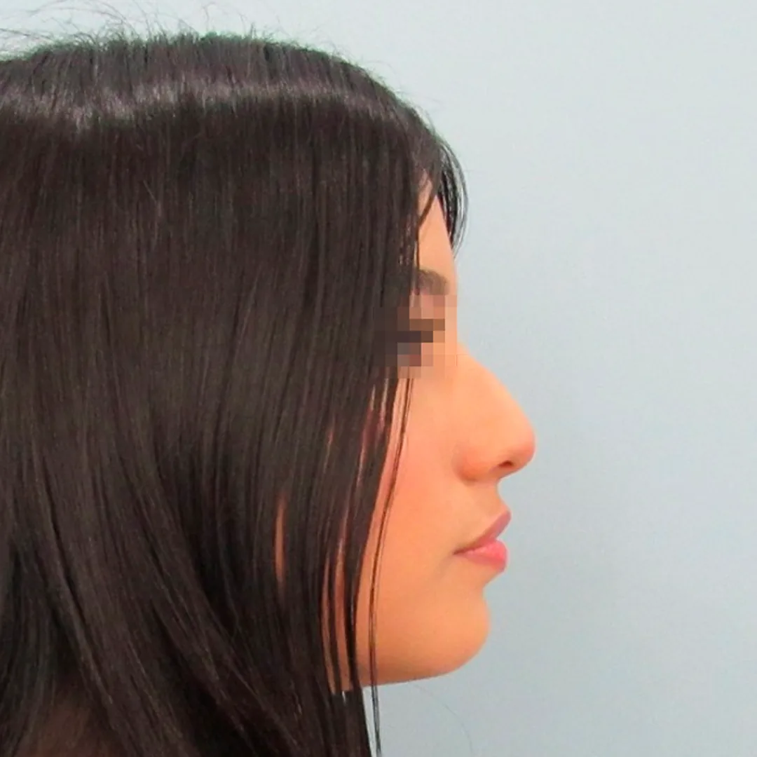 Rinoplastia — antes